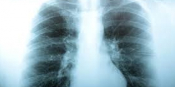 Risk stratification for cardiac complications in patients hospitalized for community-acquired pneumonia