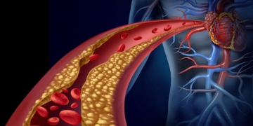 Também no oriente a dislipidemia aterogénica aumenta os eventos cardiovasculares nos diabéticos com LDL controlada