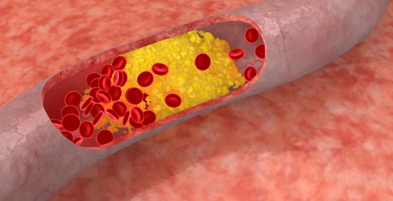 Nanomedicina com luteolina apresenta avanços no tratamento da aterosclerose