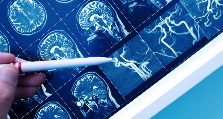 SPA e APDP alertam para ligação perigosa entre aterosclerose, diabetes e AVC